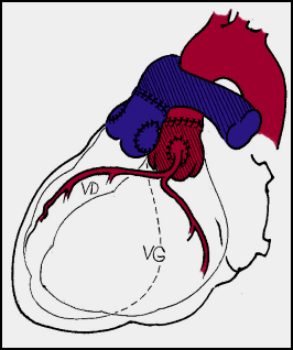 Correction (appelée switch artériel). Les gros vaisseaux sont transposés sur l’autre ventricule. A noter le transfert des artères coronaires sur le vaisseau « oxygéné ». Ce geste représente la partie la plus délicate de l’opération. 